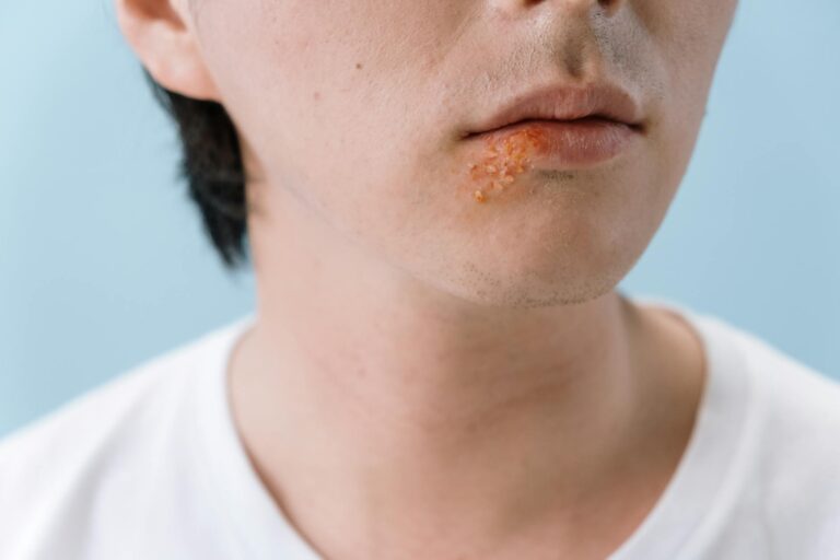 Globuli zur gezielten Behandlung von Lippenherpes effektiv einsetzen