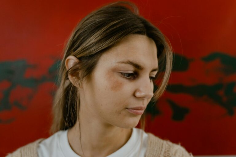 Ruta bei Prellungen und Verstauchungen: Natürliche Heilung mit Globuli